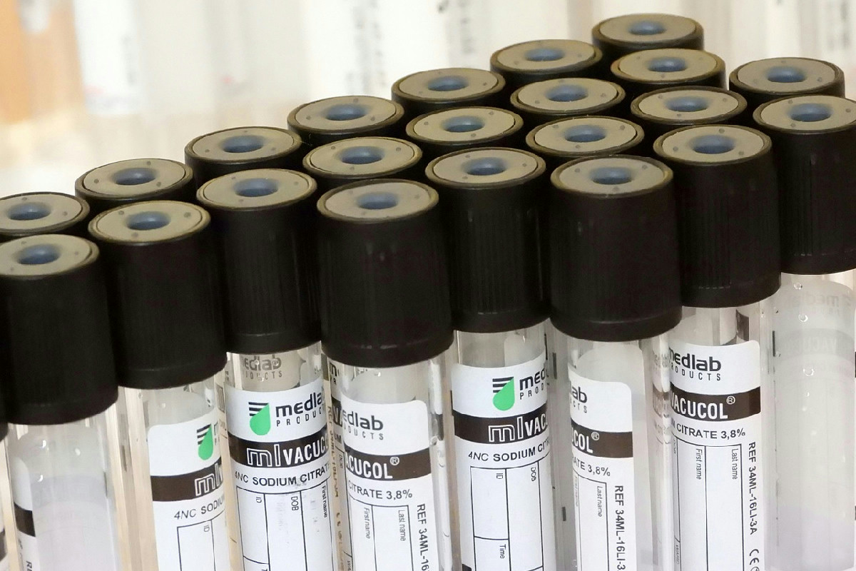 Colesterolo nel sangue: guida completa per interpretare i valori e capire i risultati degli esami